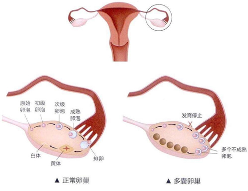 多囊做试管注意事项？多囊卵巢坐试管需要注意什么？