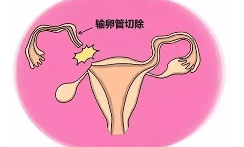 输卵管结扎后能做试管婴儿吗？女性结扎后能做试管婴儿吗？