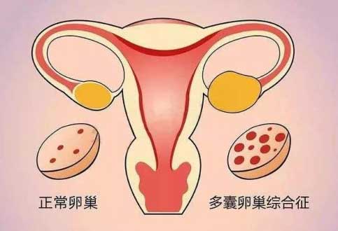 多囊性卵巢能做试管婴儿吗？多囊卵巢做试管面临那些问题！