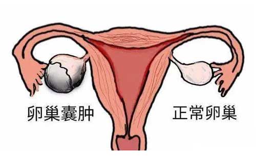 卵巢囊肿可以做试管婴儿吗？卵巢囊肿对怀孕的影响！
