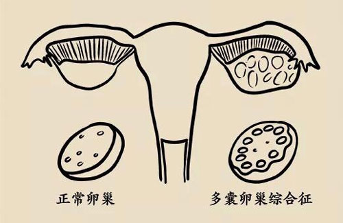 多卵巢多囊要注意什么？注意护理是非常重要而且必要的！