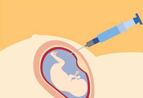 羊膜穿刺对宝宝有影响吗？一般认为羊水穿刺不会伤到胎儿！