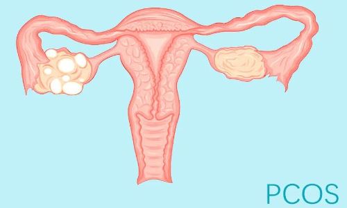 多囊卵巢可以直接做试管吗?多囊卵巢综合症做试管婴儿能成功吗?